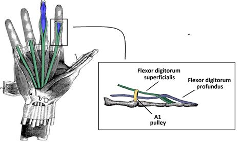 Flexor Tendon Pulleys Hand