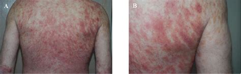 Figure 1 from Drug-Induced Lichenoid Dermatitis with Histopathologic ...