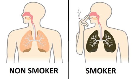 Nurse Explains What Smoking Every Day Does To Your Lungs