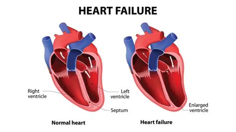 Systolic Heart Failure: Symptoms, Causes, Diagnosis, Treatment ...