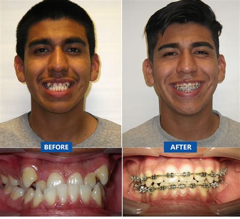 Before And After Braces Gaps