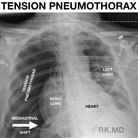 Pneumothorax Chest X Ray