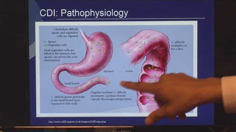 Fecal transplant helps patients of painful C.diff