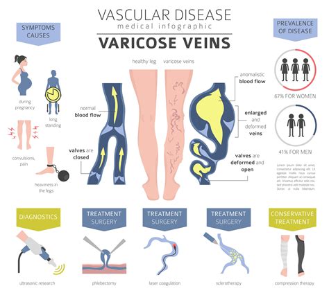 Varicose Veins - Wilton, CT & Fairfield, CT: Center for Varicose Veins ...