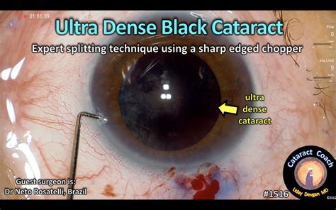 1516: ultra dense black cataract – Cataract Coach