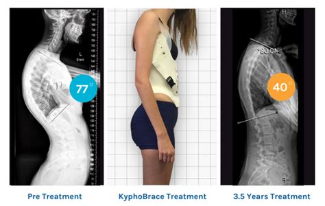 Kyphosis Brace