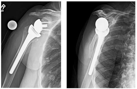 Reverse Shoulder Replacement | Shoulder Arthritis | Colorado Shoulder ...