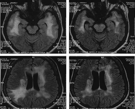 Hashimoto Encephalopathy: Clinical and MRI Improvement Follo... : The ...