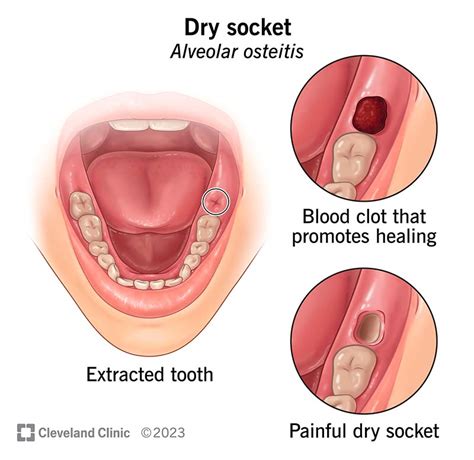 What Does Dry Socket Look Like After Wisdom Tooth Extraction