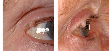 A benign or malignant eyelid lump – can you tell? An unusual collision ...