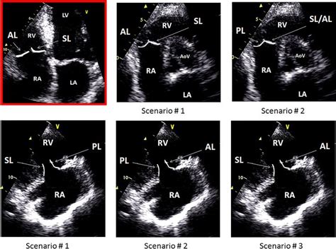 Anatomy of tricuspid valve | Tricuspid valve, Cardiac sonography, Echo