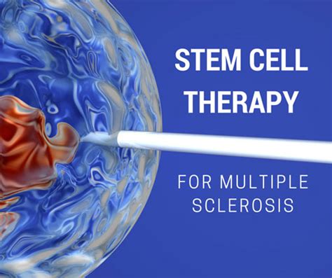 Stem Cell Therapy for Multiple Sclerosis | Cellgen