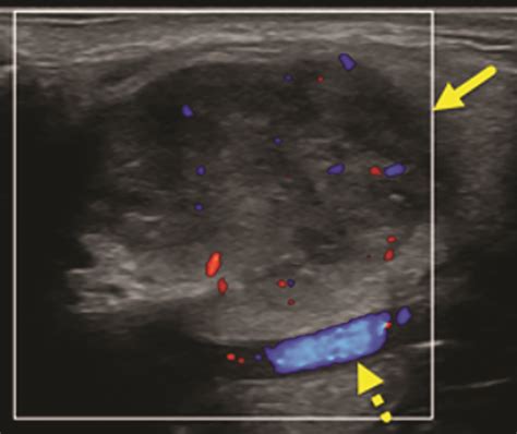 Pleomorphic Adenoma of the Parotid Gland • APPLIED RADIOLOGY