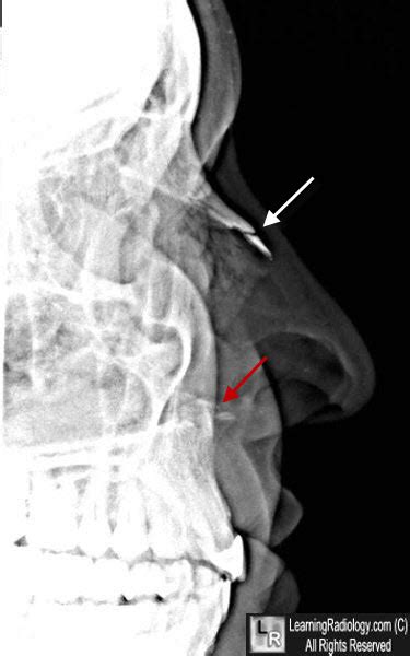 Nasal Fracture X Ray