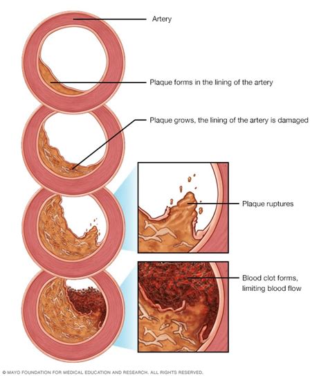 Heart disease - Symptoms and causes - Mayo Clinic