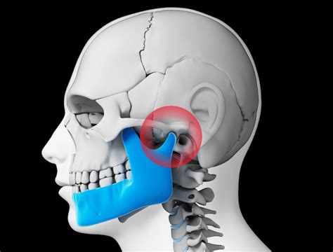 Temporomandibular Joint Disorder (TMD or TMJ) | TMJ Treatment in ...