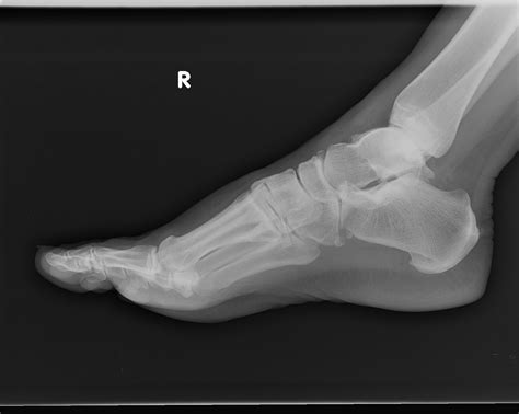 Radiology Cases: Fractured Os Peroneum, Painful Os Peroneum Syndrome (POPS)