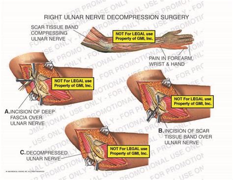 Right Ulnar Nerve Decompression Surgery 98084c31b – Generic Medical ...