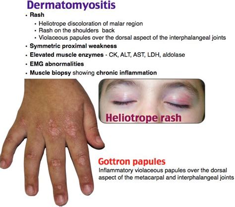 Dermatomyositis F>M Polymyositis + rash Rash Malar rash Heliotrope rash ...