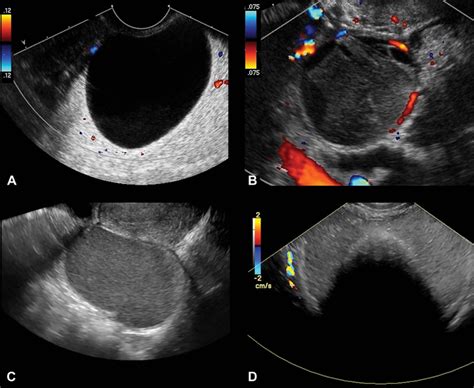 Researchers use ultrasound to predict ovarian | EurekAlert!