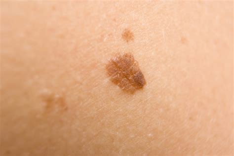 Brown Spots on Skin - Prevention, Treatment and Home Remedies