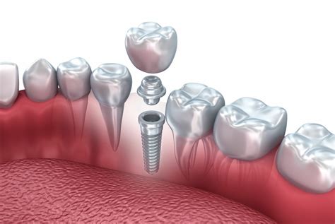 The Causes of Missing Teeth | Bolingbrook, IL | Suburban Oral Surgery ...