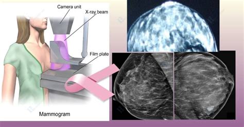 Mammogram for dense breasts. Things you must know.