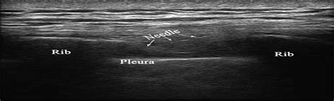 Ultrasound-guided Pulsed Radiofrequency in the Management of... : The ...