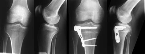 High Tibial Osteotomy Procedure for Knee Arthritis