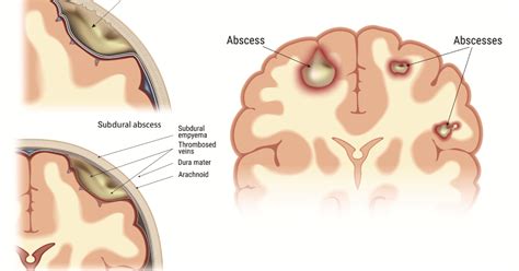 Stages Of Brain Abscess