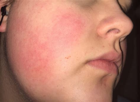 [skin concerns] [routine help] help evening out red cheeks ...