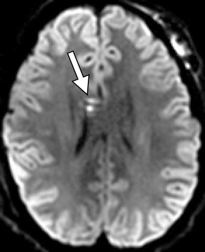 Traumatic Brain Injury: Imaging Patterns and Complications | RadioGraphics