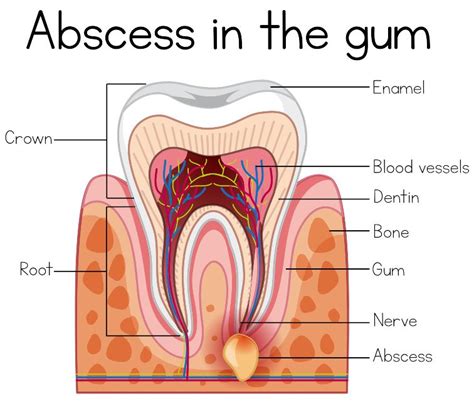 Dental Cysts - Causes, Types and How To Properly Treat Them