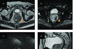 Imaging findings of the prostate. Multiparametric MRI demonstrated a ...