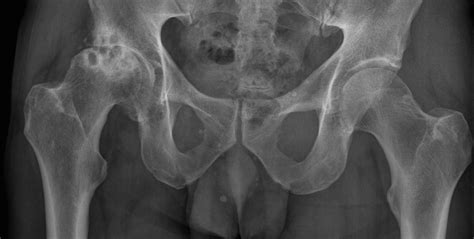 Osteoarthritis – hip - Radiology at St. Vincent's University Hospital