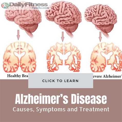 Alzheimer'S Disease Review 2024 - Brook Collete