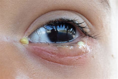 Crusty Eyes in the Morning - What to Do About that Sticky Mucus ...