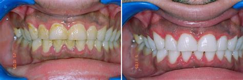 Scaling and Polishing - Platinum Dental Surgery