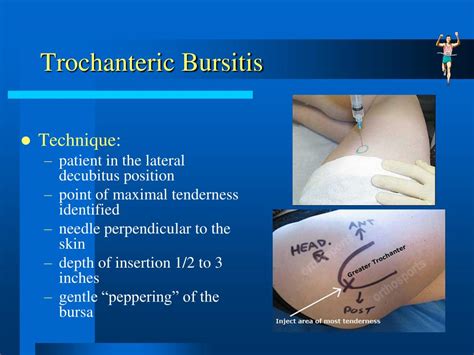 Hip Trochanteric Bursitis Injection