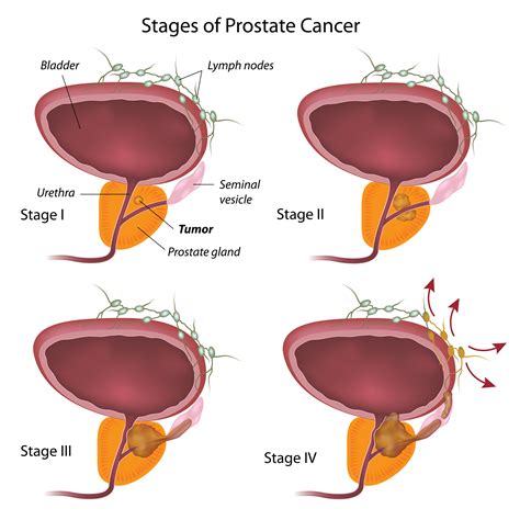 Prostate Cancer Stages - University Health News