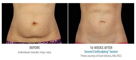 Coolsculpting Before and After Photos - Center For Medical Aesthetics