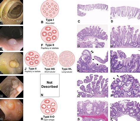 The cutting edge of serrated polyps: a practical guide to approaching ...