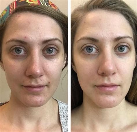 19 Skincare Products With Dramatic Before-And-After Photos | Natural ...