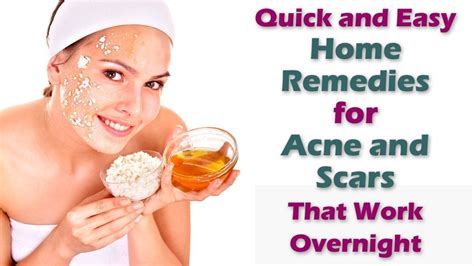 Acne Home Remedy - Fast And Best Natural Methods To Get Rid Of Your ...