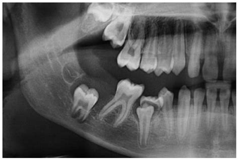 Dentistry Journal | Free Full-Text | Unusual Imaging Features of ...