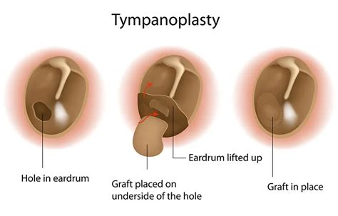 Tympanic Membrane Perforation Repair