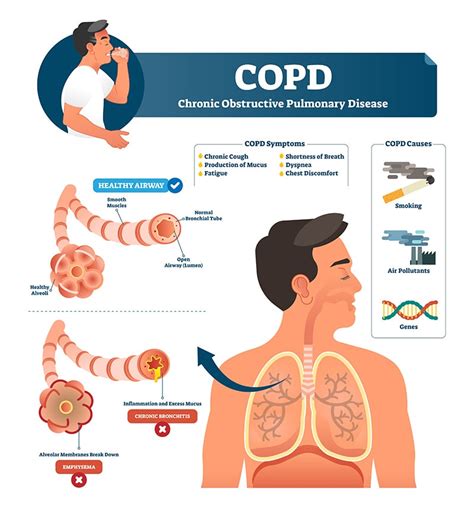 COPD - Never take a single breath for granted. - St. Clair Health Blog