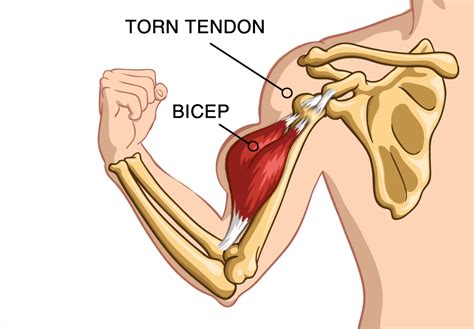 Popeye Arm Deformity - Torn Tendon, Bicep Implants, Orange County