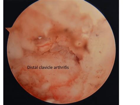 Shoulder and Elbow Surgery: Arthroscopic Mumford procedure for AC joint ...