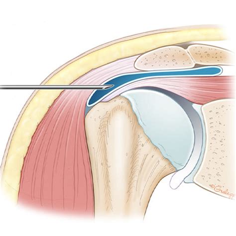 Subdeltoid Bursitis